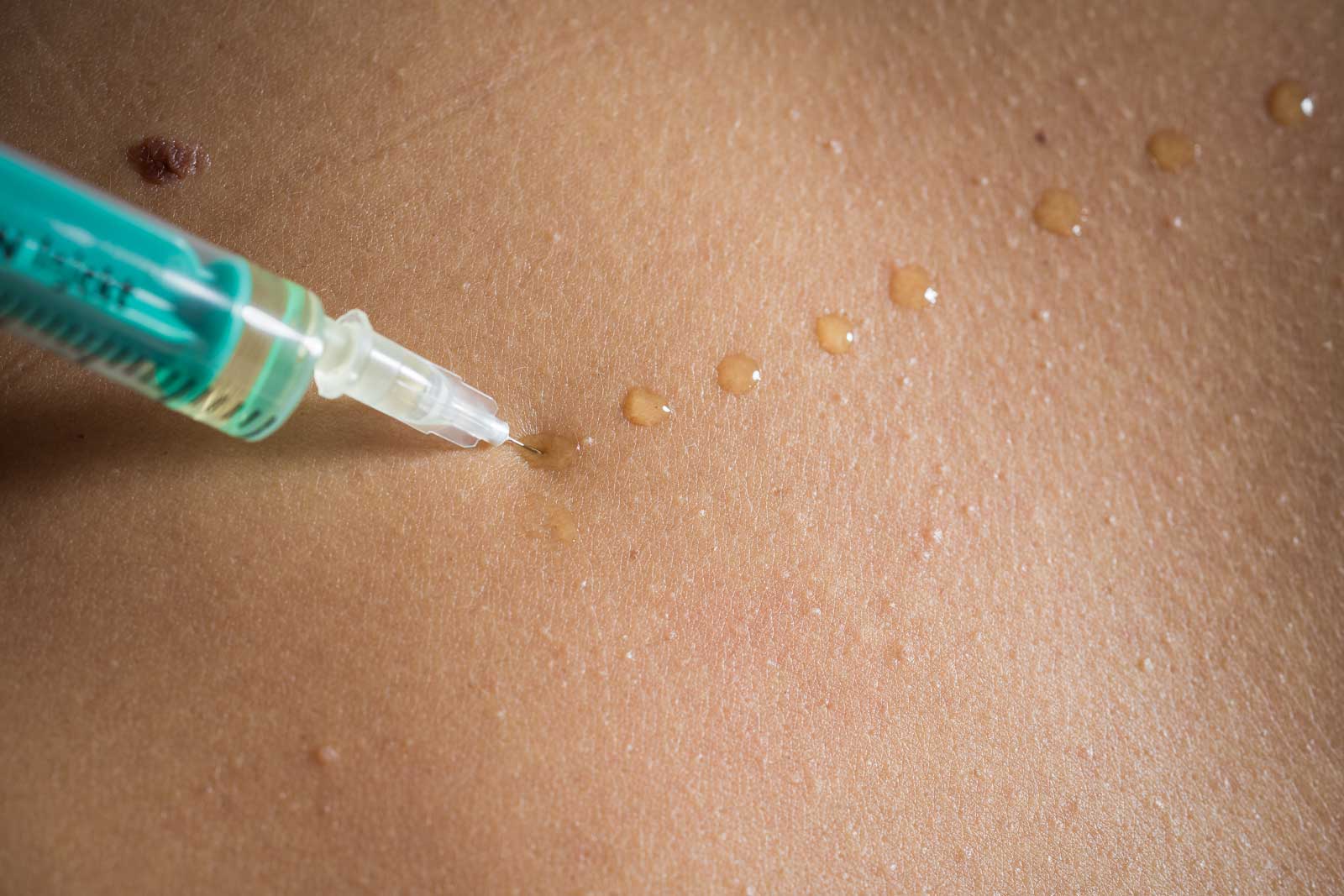 Lara Müllneritsch | Mesotherapie