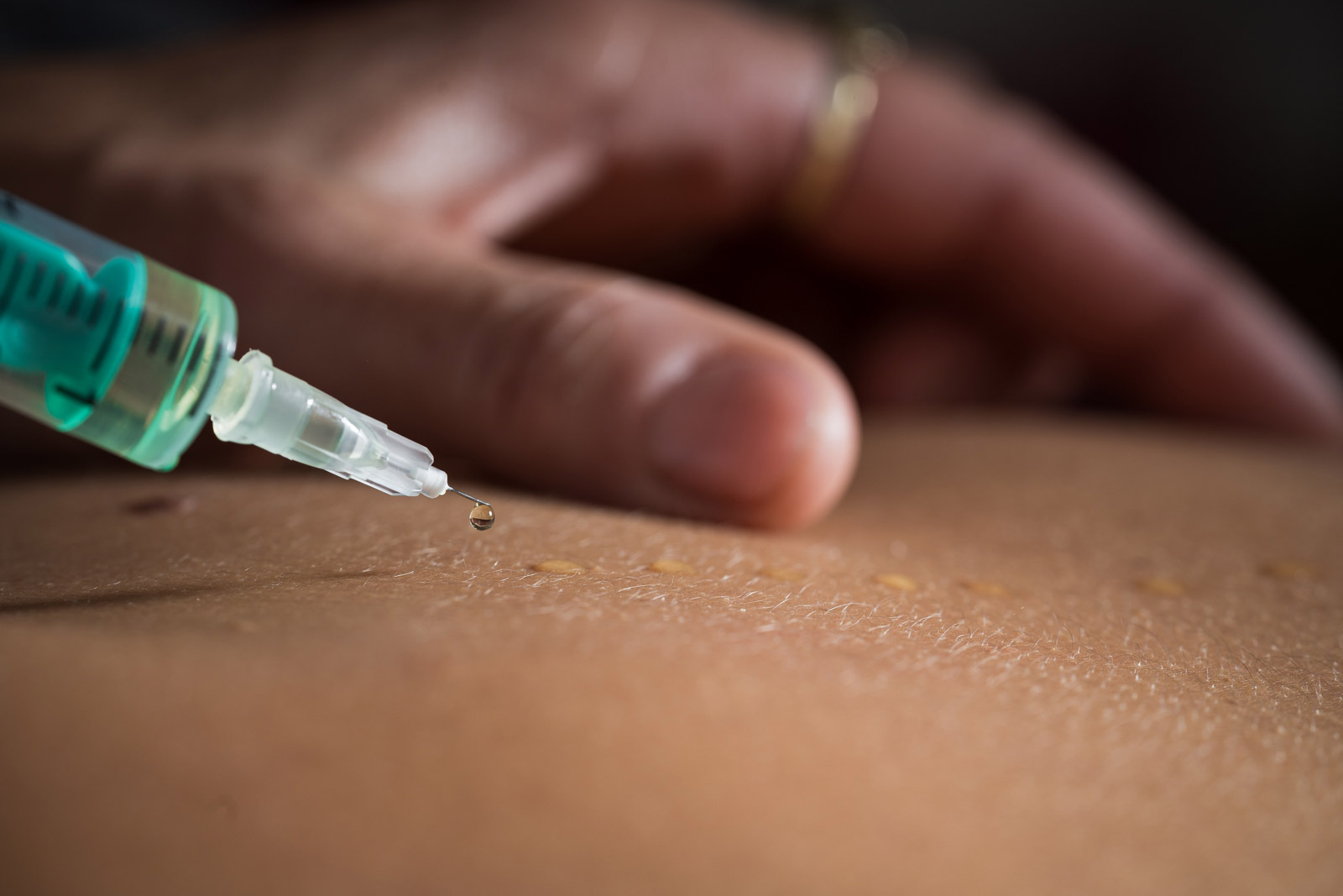 Lara Müllneritsch | Mesotherapie